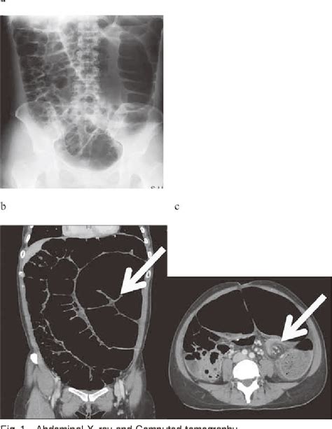 Figure 1 From A Case Of Anaphylactic Shock Due To Latex Allergy In A