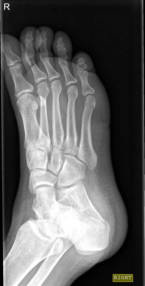 Avulsion Fracture Of The Cuboid Image