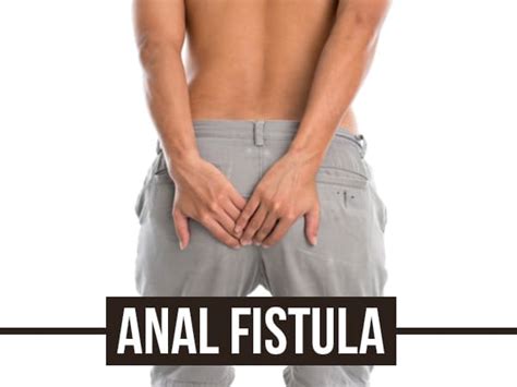 Anal Fistula Causes Risk Factors Symptoms Diagnosis Treatments And