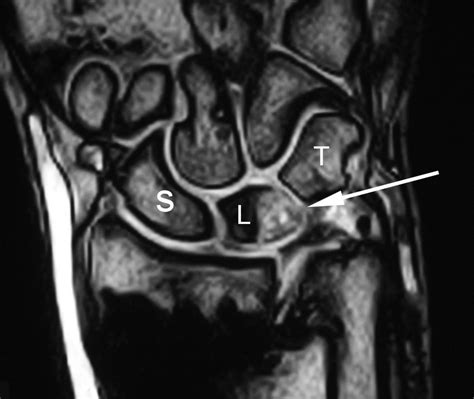 Arthroscopic Management Of Ulnocarpal Impaction Syndrome And Ulnar