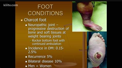 Dr Is In Charcot Foot
