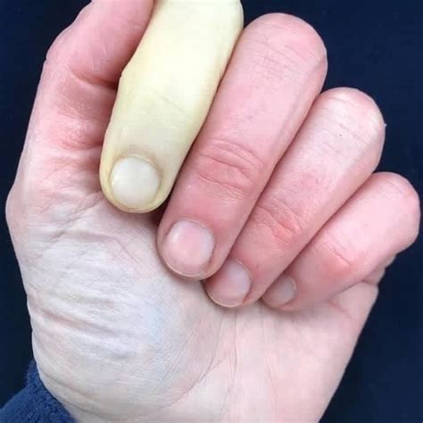 reynaud syndrome pictures hand and finger fingers turn white and numb nigerian health blog