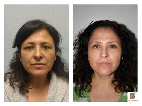 Facial Cosmetic Surgery Before And After Photos