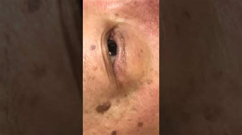 Year Face Cyst Cyst Removal Clinic London Dr Khaled Sadek Pimple