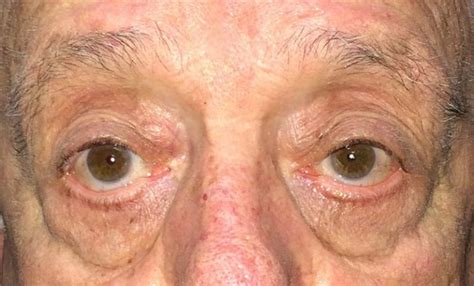 Correction Of Drooping Upper Eyelids Ptosis After Nissman Eye