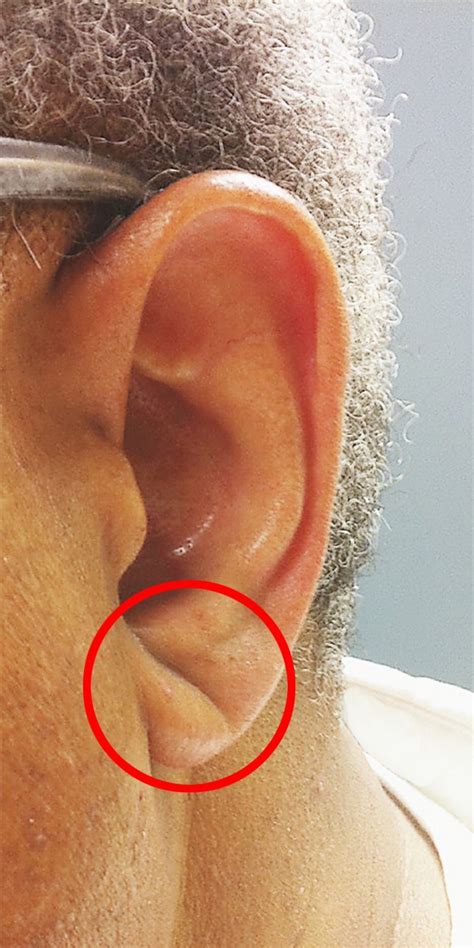 If Your Ear Lobe Looks Like This You Could Be At Higher Risk Of A Stroke Metro News