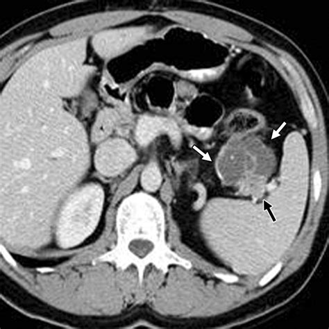 Diagnosis And Management Of Cystic Pancreatic Lesions Ajr