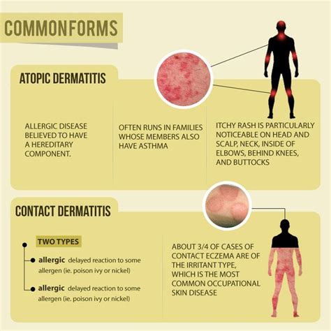 Common Forms Of Eczema Eczema Atopic Dermatitis Facial Eczema