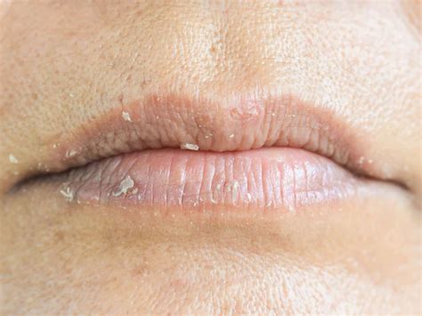 Lip Cancer What It Looks Like And What To Do