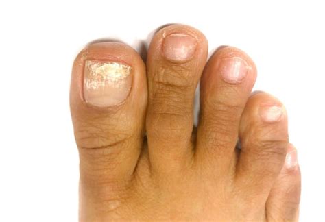 White Superficial Onychomycosis Types Symptoms Causes And Treatment