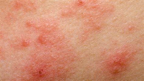 Eczema Vs Skin Cancer Gentlecure