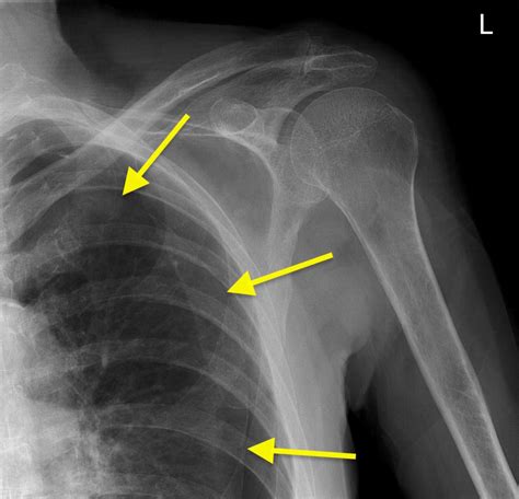 Pneumothorax On Shoulder X Ray Radiology At St Vincents University
