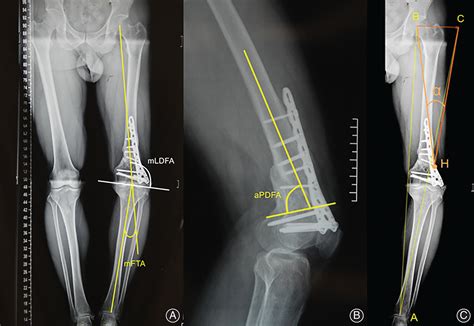 Medial Open‐wedge Osteotomy With Double‐plate Fixation For Varus