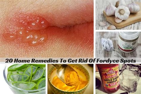 20 Home Remedies To Get Rid Of Fordyce Spots Wellnessguide