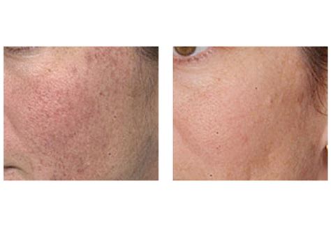 Laser For Broken Capillaries On Face Side Effects Cosmetic Surgery Tips