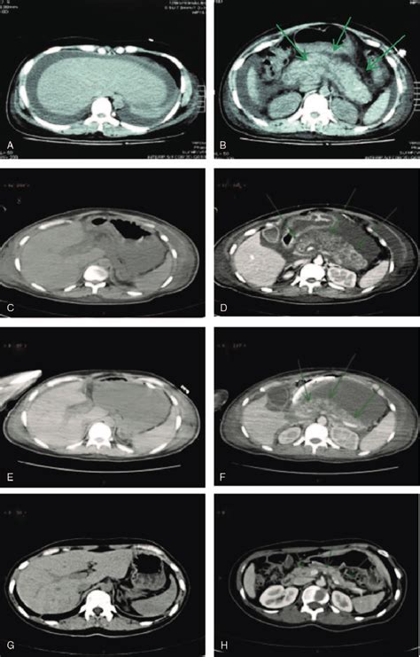 Abdominal Computed Tomography Findings A Diffuse Decrease Of Hepatic