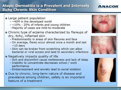 Atopic Dermatitis Overview