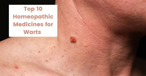 Homeopathic Wart Treatment Causes And 10 Best Medicines
