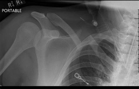 Midshaft Clavicle Fractures Trauma Orthobullets