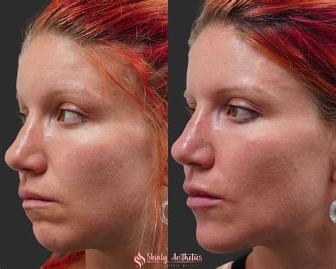 Chin Fillers Before After Results At Skinly