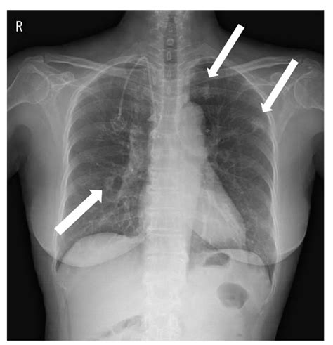 Pulmonary Embolism Chest X Ray
