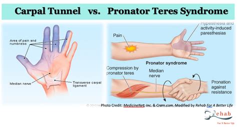 Carpal Tunnel Vs Pronator Teres Syndrome Rehab For A Better Life