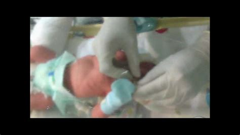 Neonatal Digital Intubation Part 1 Youtube