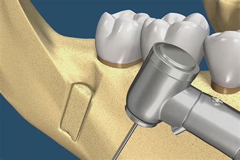 Bone Grafting Materials