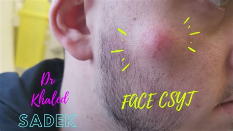 Large Face Cyst Removed Dr Khaled Sadek Youtube