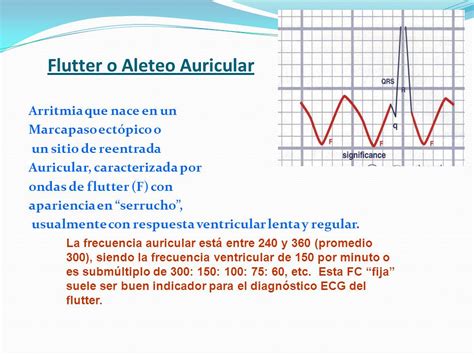 FLUTTER O ALETEO AURICULAR PDF