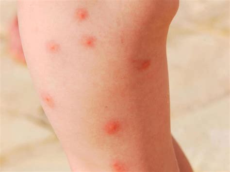 Skin Creams To Help Heal Insect Bites