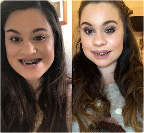 Double Jaw Surgery The Recovery