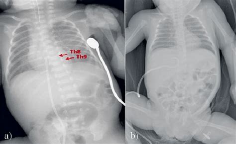 A Normal Radiographic Appearance Of The Umbilical Venous Catheter The