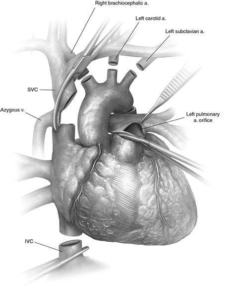 Heart Transplantation Donor Operation For Heart And Lung