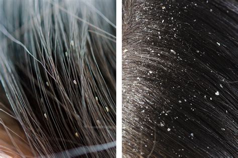 Heres How To Spot The Difference Between Lice And Dandruff Dandruff