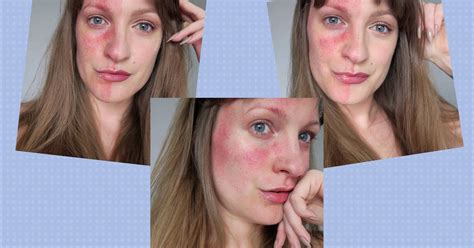 Best Skincare Products For Rosacea