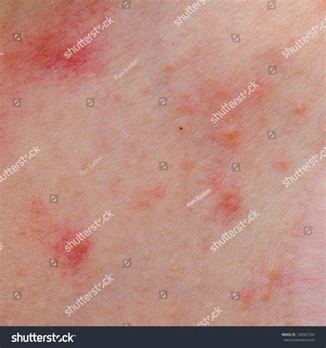 Ill Allergic Rash Dermatitis Eczema Skin Of Patient Stock Photo