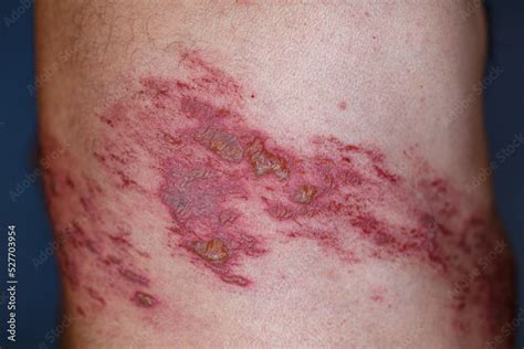 Foto Stock Skin Lesion Symptom In Shingles Or Herpes Zoster In Human