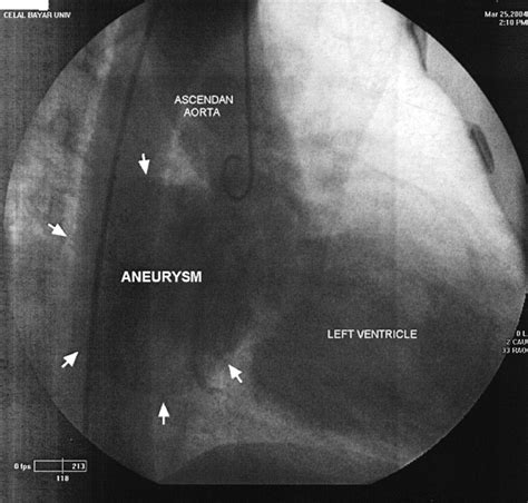 Giant Unruptured Noncoronary Sinus Of Valsalva Aneurysm Circulation