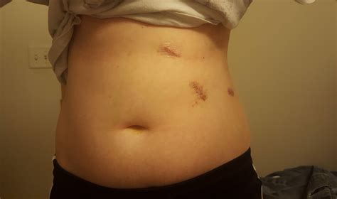 But if your doctor recommends imaging, you generally don't need any special preparation for an ultrasound or mri. Rare blood disorder, Hereditary Spherocytosis. Just had my ...