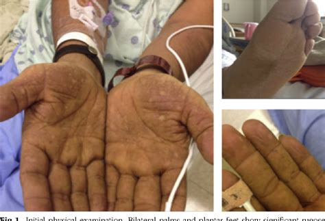 Figure 1 From Acquired Acanthosis Nigricans With Tripe Palms In A