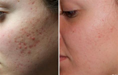 Common Acne Scars And How To Get Rid Of Them Readers Digest