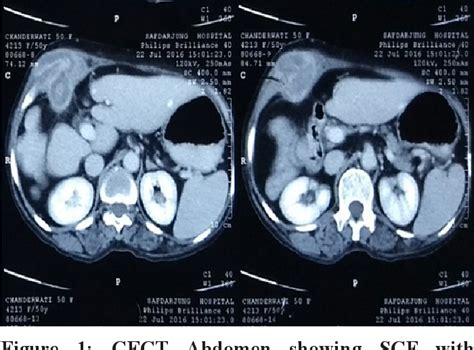 Figure 1 From Spontaneous Cholecystocutaneous Fistula In A Case Of