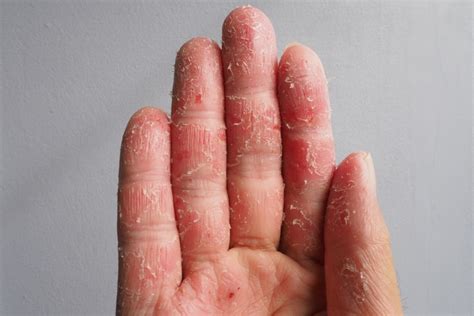 Eczema Cronico Della Mano Delgocitinib In Crema Migliora Signific