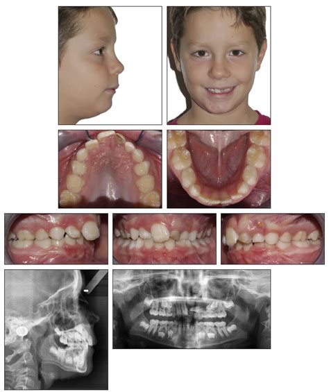 Dentigerous Cyst Canine