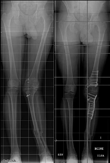 Full Length Standing Ap Radiograph Of Both Lower Extremities Before