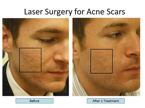 The Best Lasers To Treat Acne Scars Fractional Co2 Laser Fraxel