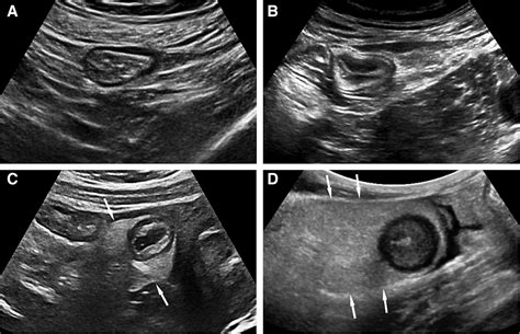 Bowel Ultrasound State Of The Art Grayscale And Doppler Ultrasound