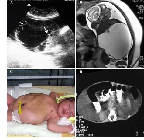 A 26 Week Fetus With Chylous Ascitis A Axial Grayscale Sonogram Shows