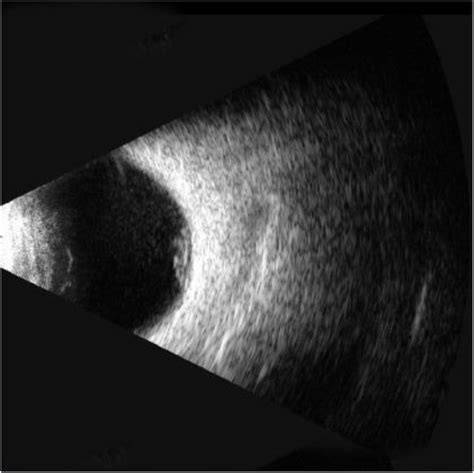 B Ultrasound Of The Left Eye Showing Mild Vitreous Opacity And Highly